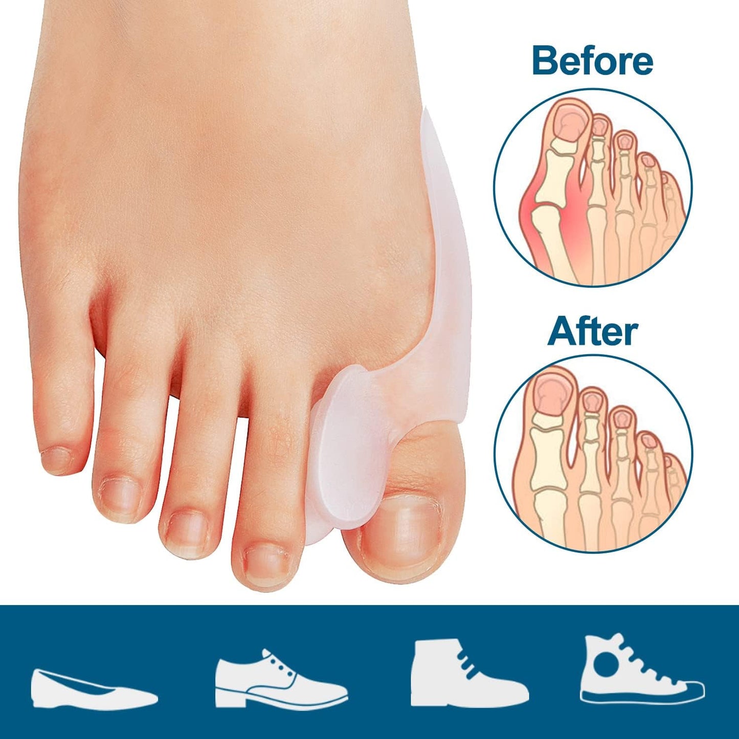Bunion Toe Protector (OM14-013)